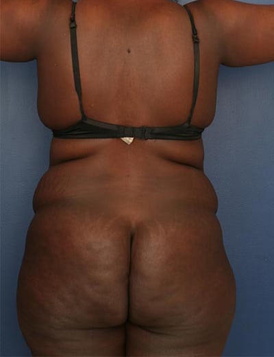 Before Image: Tummy Tuck - back