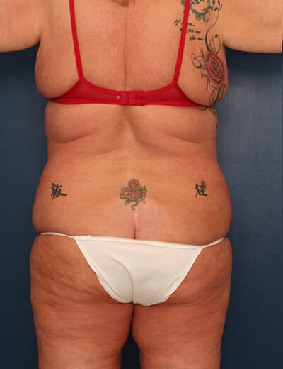 Before Image: Tummy Tuck - back