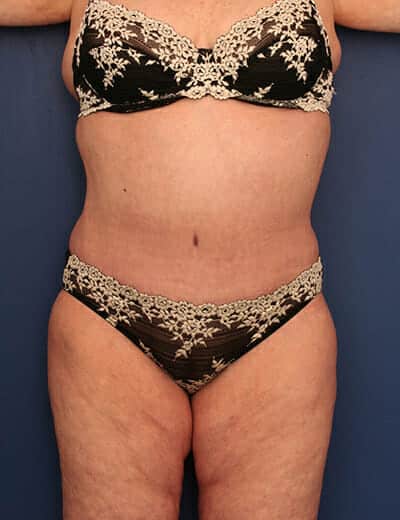 After Image: Tummy Tuck - front