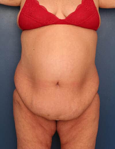 Before Image: Tummy Tuck - front