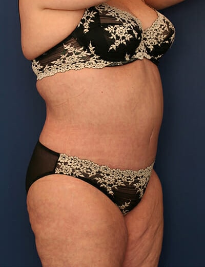 After Image: Tummy Tuck - right-front-oblique