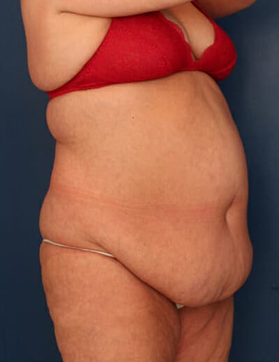 Before Image: Tummy Tuck - right-front-oblique