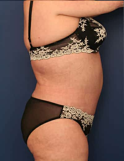 After Image: Tummy Tuck - right-side