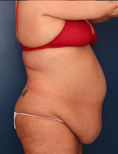Before Image: Tummy Tuck - right-side