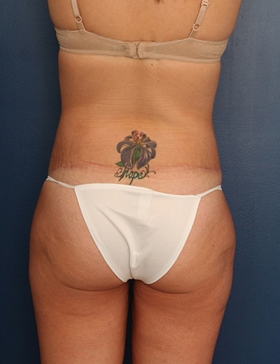 After Image: Tummy Tuck - back