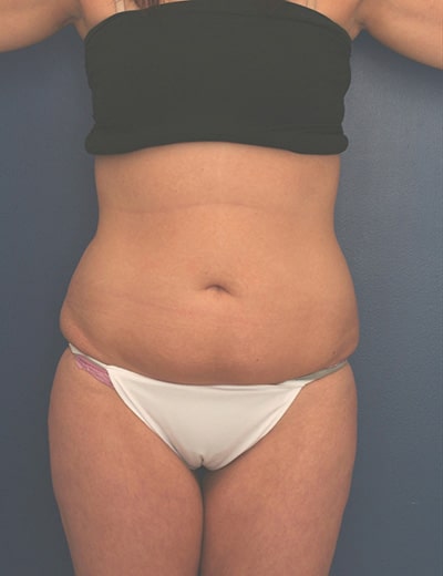 Before Image: Tummy Tuck - front