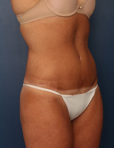 After Image: Tummy Tuck - right-front-oblique