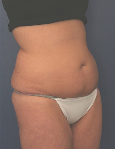 Before Image: Tummy Tuck - right-front-oblique