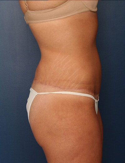 After Image: Tummy Tuck - right-side