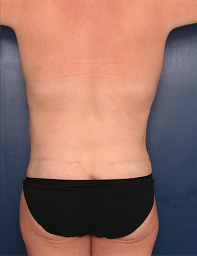 After Image: Tummy Tuck - back