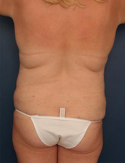 Before Image: Tummy Tuck - back