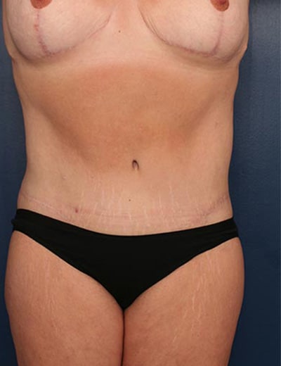 After Image: Tummy Tuck - front