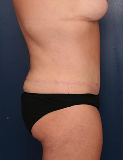 After Image: Tummy Tuck - right-side