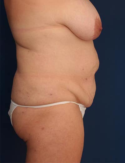 Before Image: Tummy Tuck - right-side