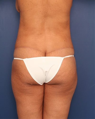 After Image: Tummy Tuck - back