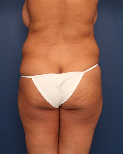 Before Image: Tummy Tuck - back
