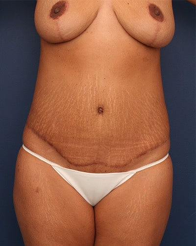 After Image: Tummy Tuck - front