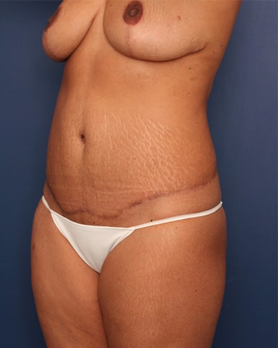 After Image: Tummy Tuck - left-front-oblique