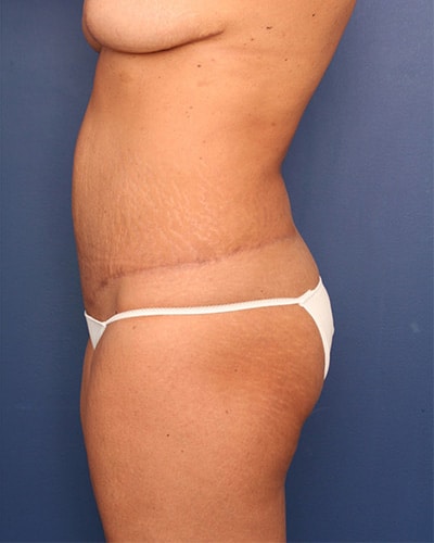 After Image: Tummy Tuck - left-side