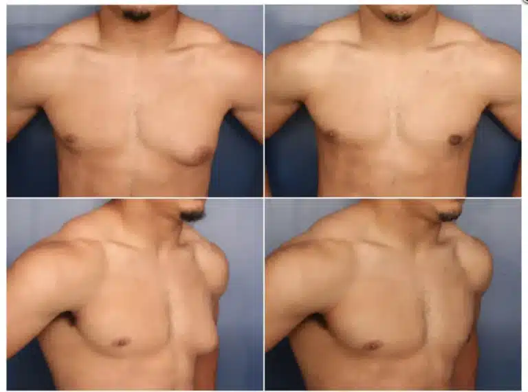 before after gynecomastia surgery