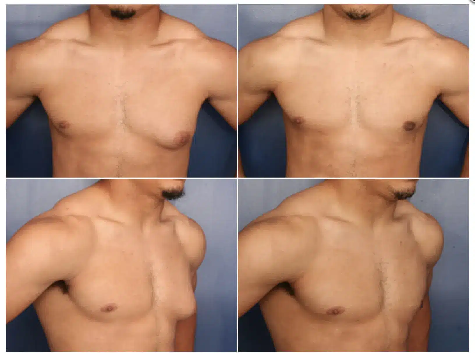 before after gynecomastia surgery