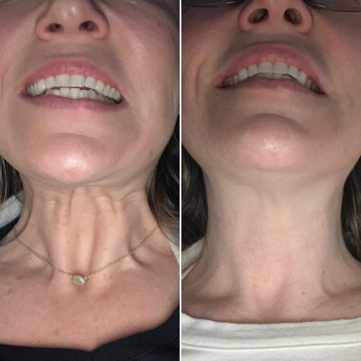 Before and After Image of Nefertiti Lift Baltimore