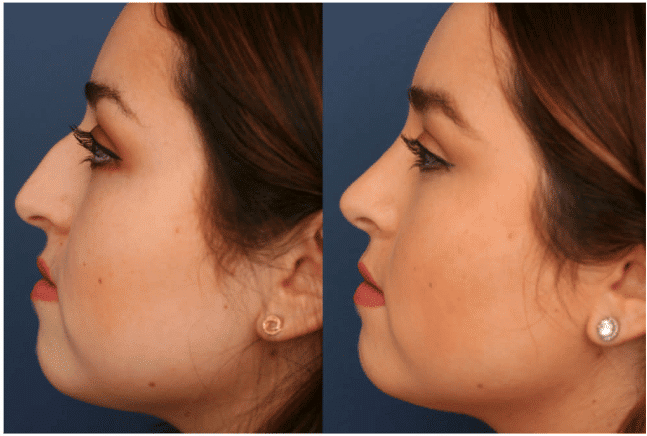 rhinoplasty before after images