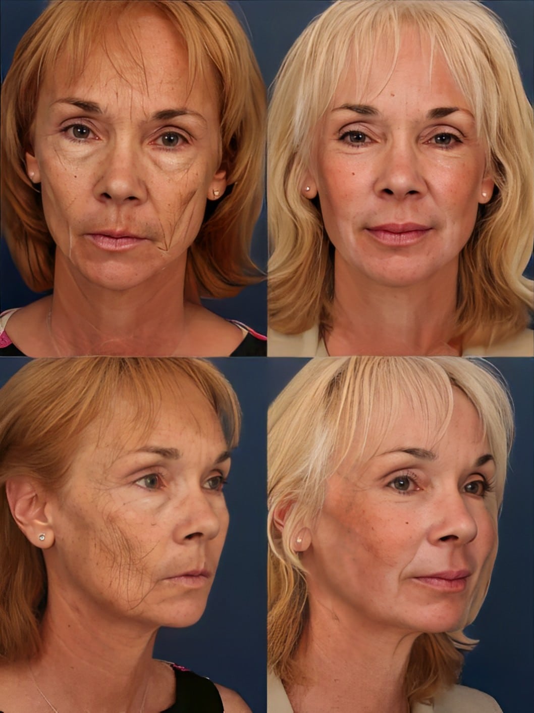 Laser resurfacing patient