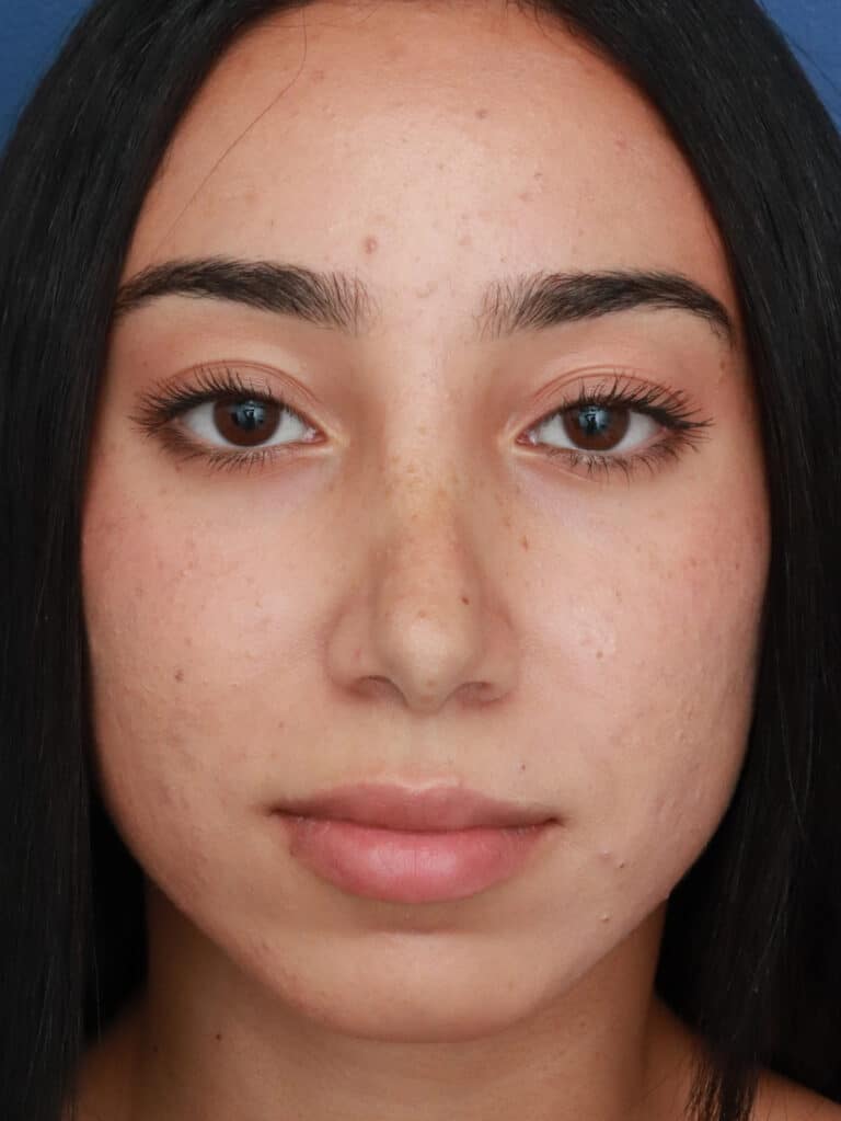 After Image: Ethnic Rhinoplasty - front