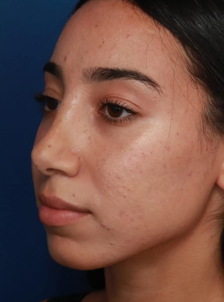 After Image: Ethnic Rhinoplasty - left-front-oblique