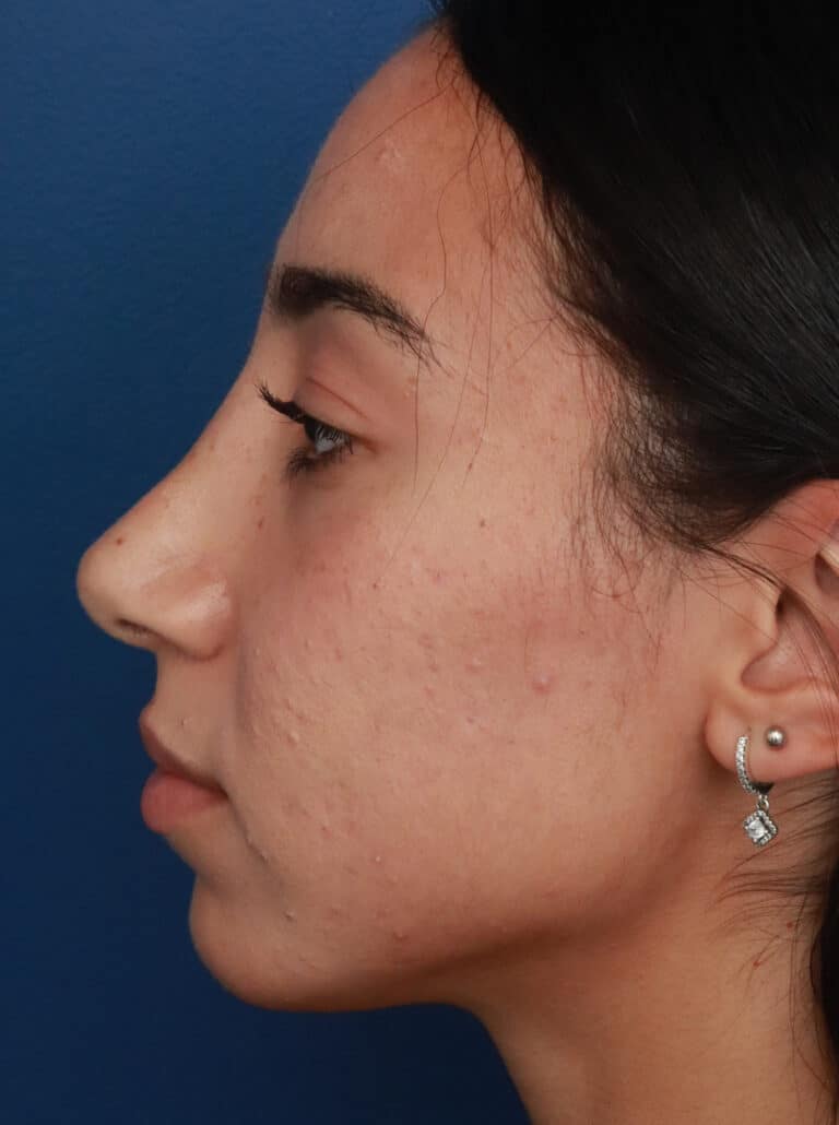 After Image: Ethnic Rhinoplasty - left-side