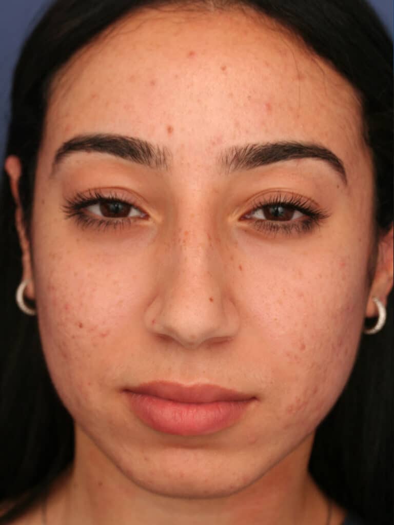 Before Image: Ethnic Rhinoplasty - front
