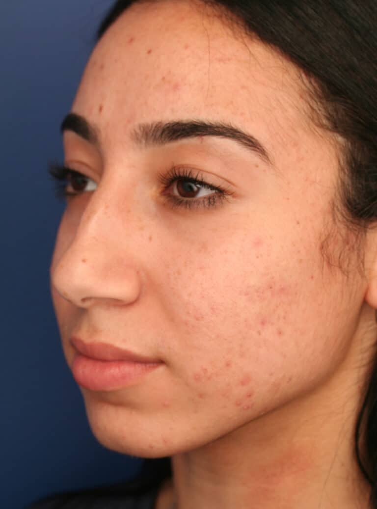 Before Image: Ethnic Rhinoplasty - left-front-oblique