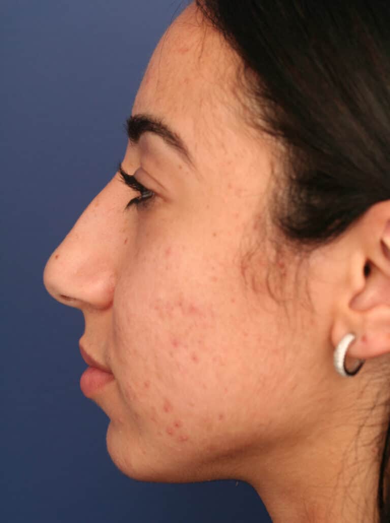 Before Image: Ethnic Rhinoplasty - left-side