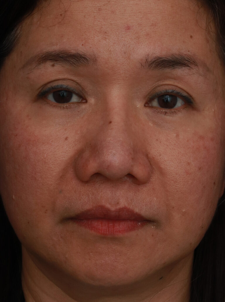 After Image: Ethnic Rhinoplasty - front
