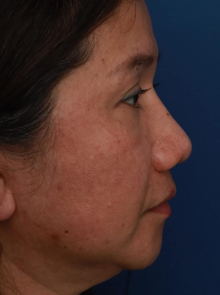 After Image: Ethnic Rhinoplasty - right-side