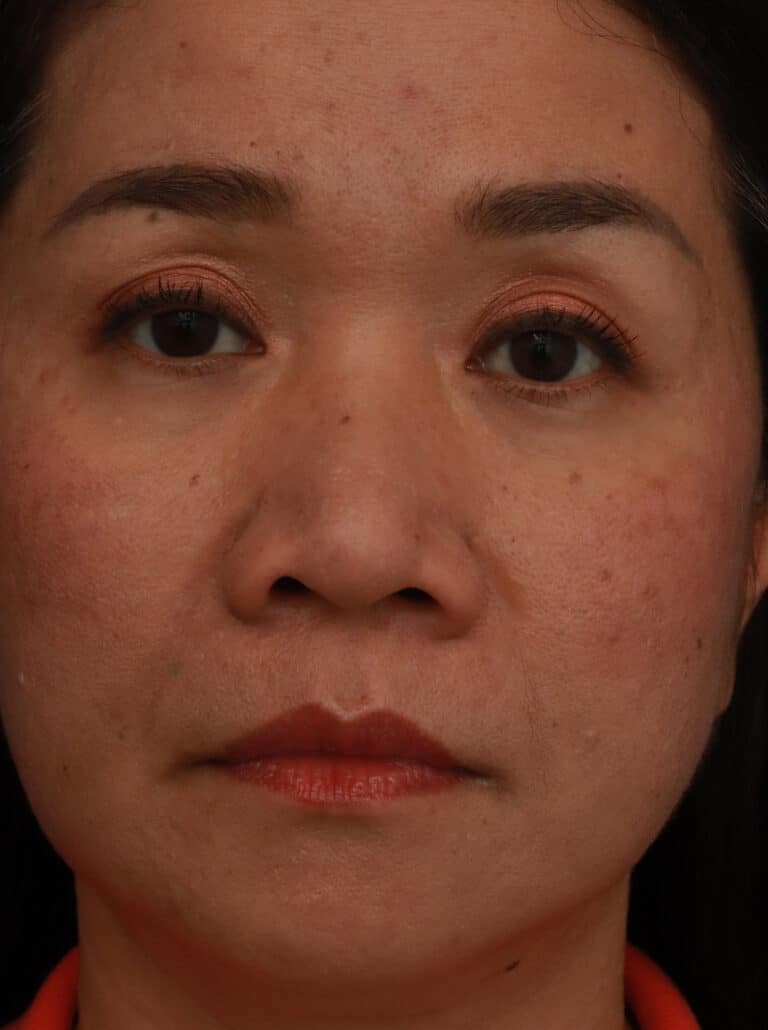 Before Image: Ethnic Rhinoplasty - front