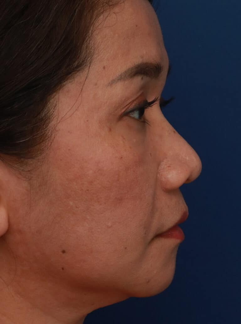 Before Image: Ethnic Rhinoplasty - right-side