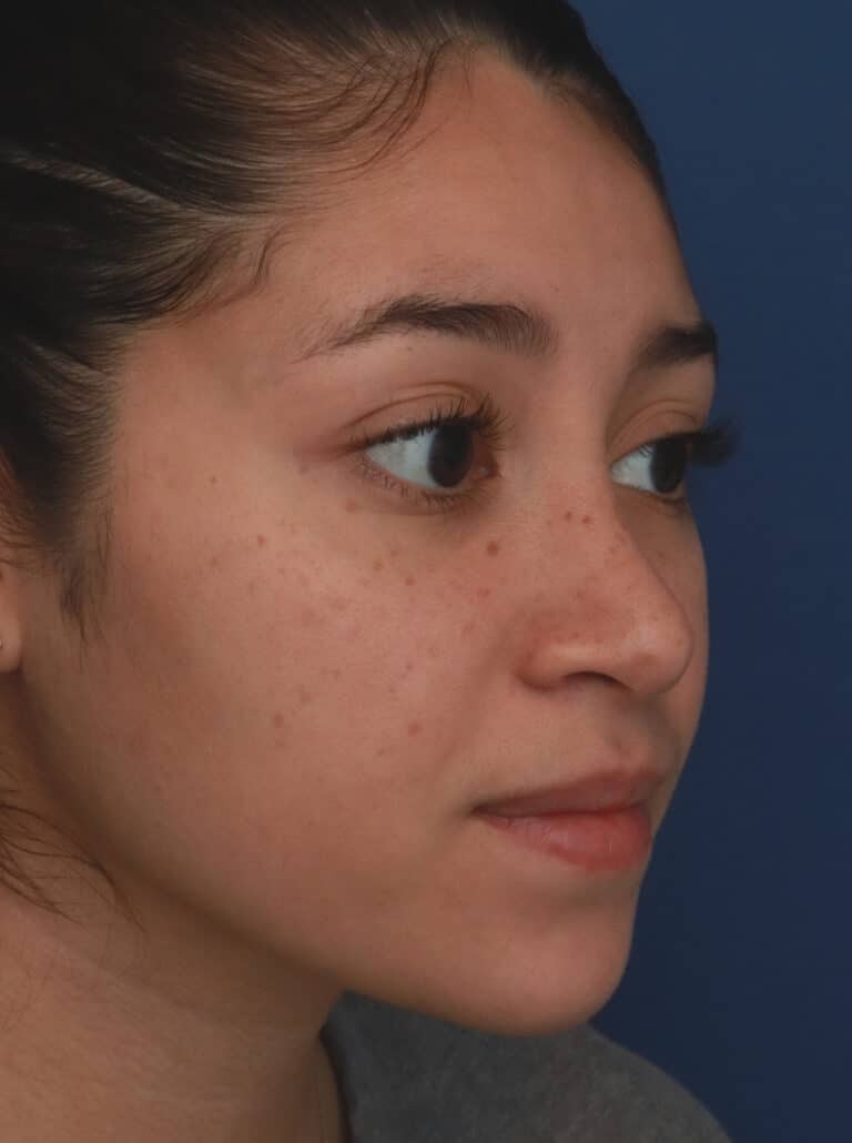 After Image: Ethnic Rhinoplasty - right-front-oblique