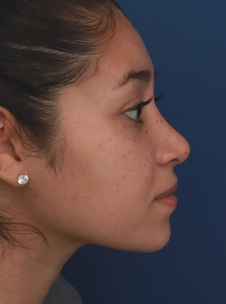 After Image: Ethnic Rhinoplasty - right-side