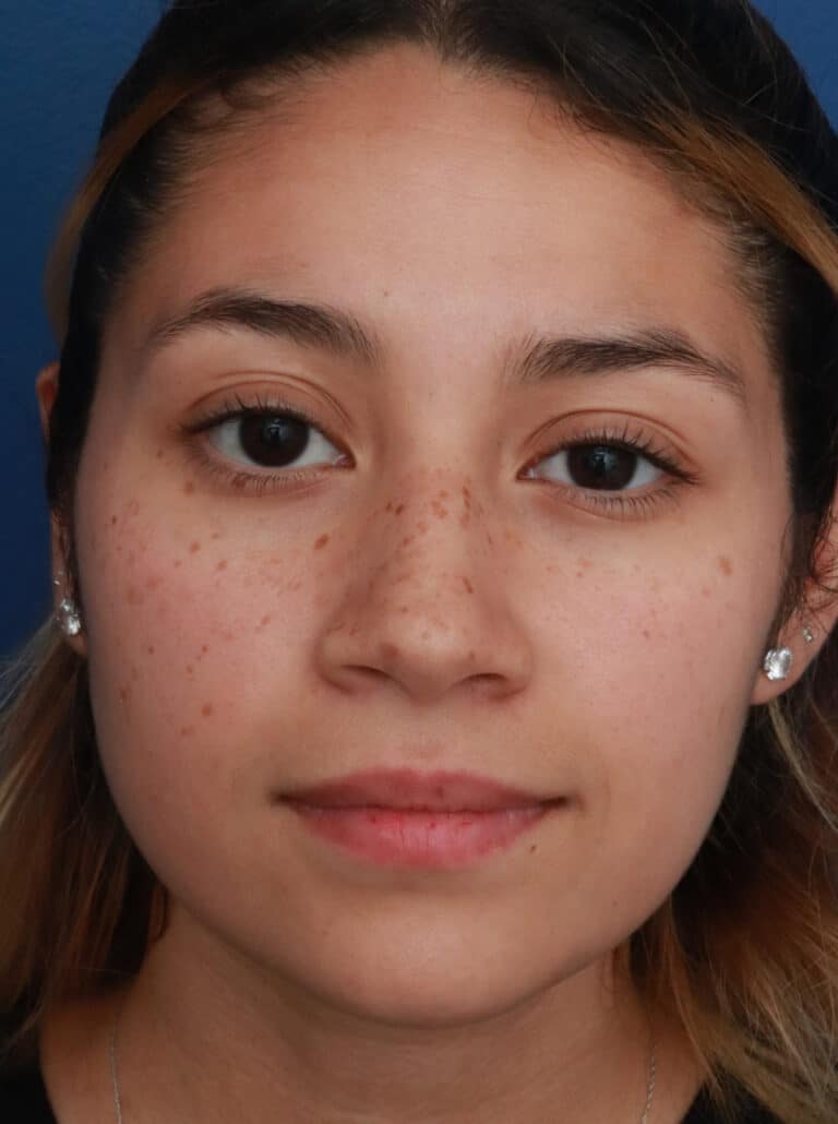 Before Image: Ethnic Rhinoplasty - front