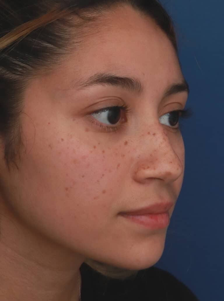 Before Image: Ethnic Rhinoplasty - right-front-oblique