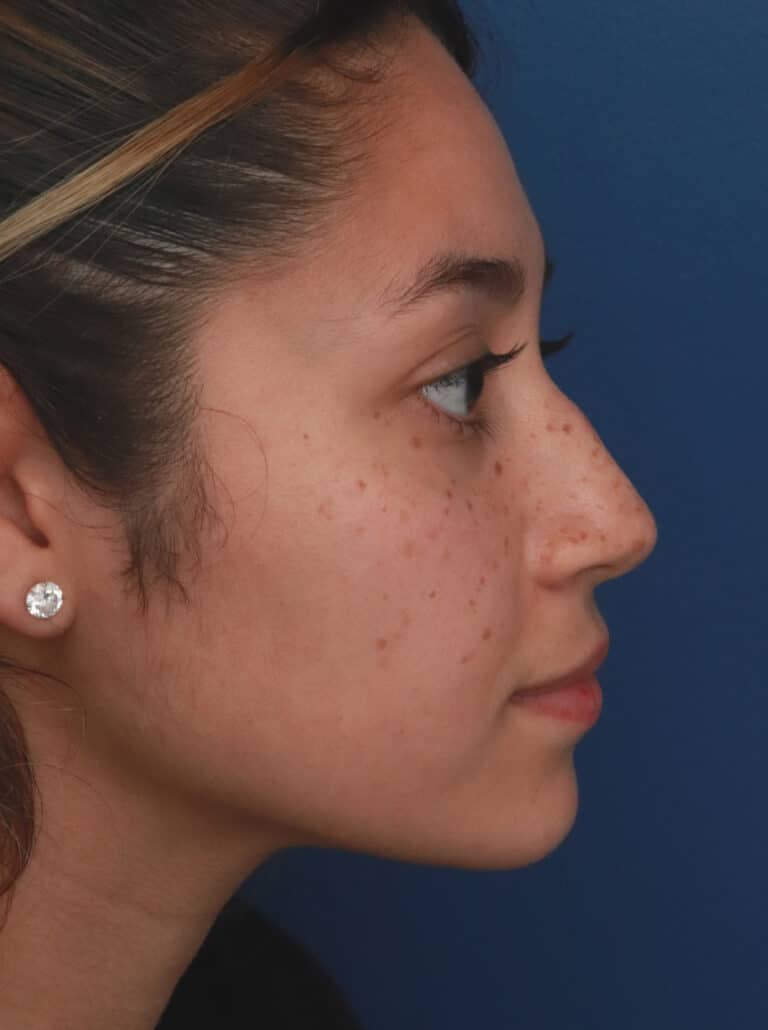 Before Image: Ethnic Rhinoplasty - right-side