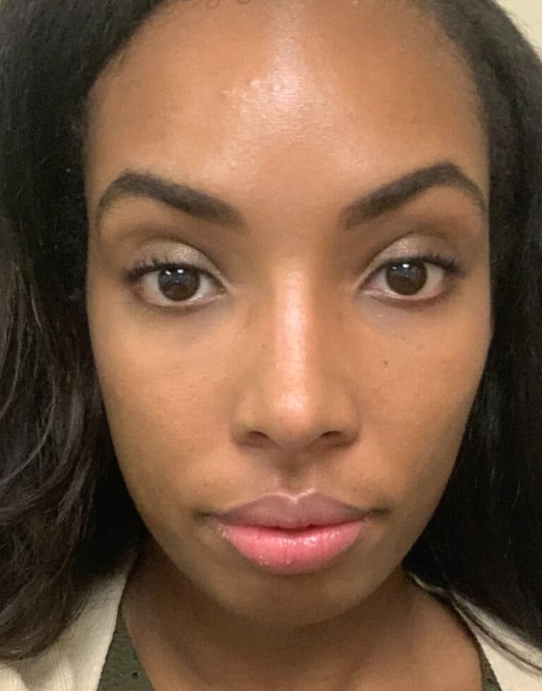 After Image: Ethnic Rhinoplasty - front