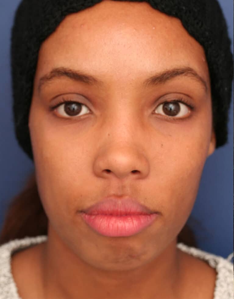 Before Image: Ethnic Rhinoplasty - front
