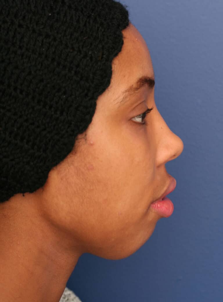 Before Image: Ethnic Rhinoplasty - right-side