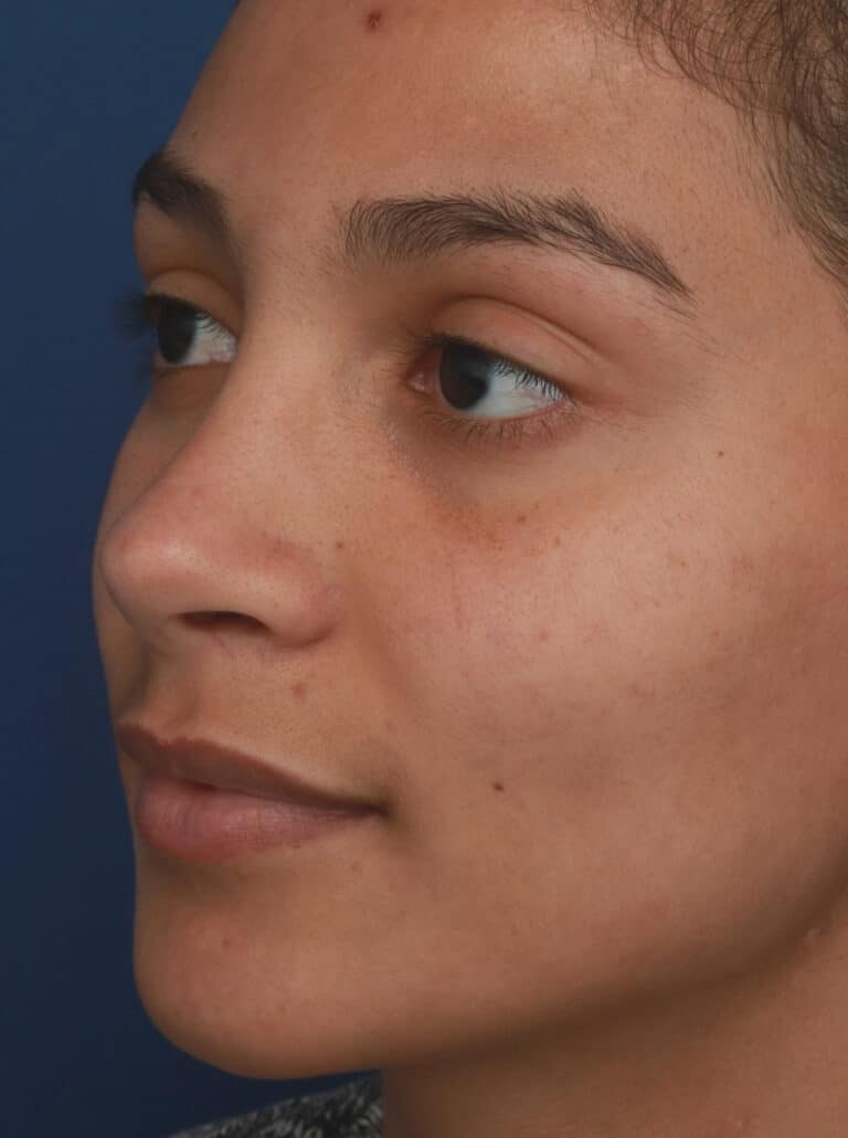 After Image: Ethnic Rhinoplasty - left-front-oblique