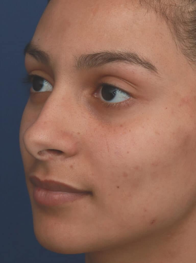 Before Image: Ethnic Rhinoplasty - left-front-oblique