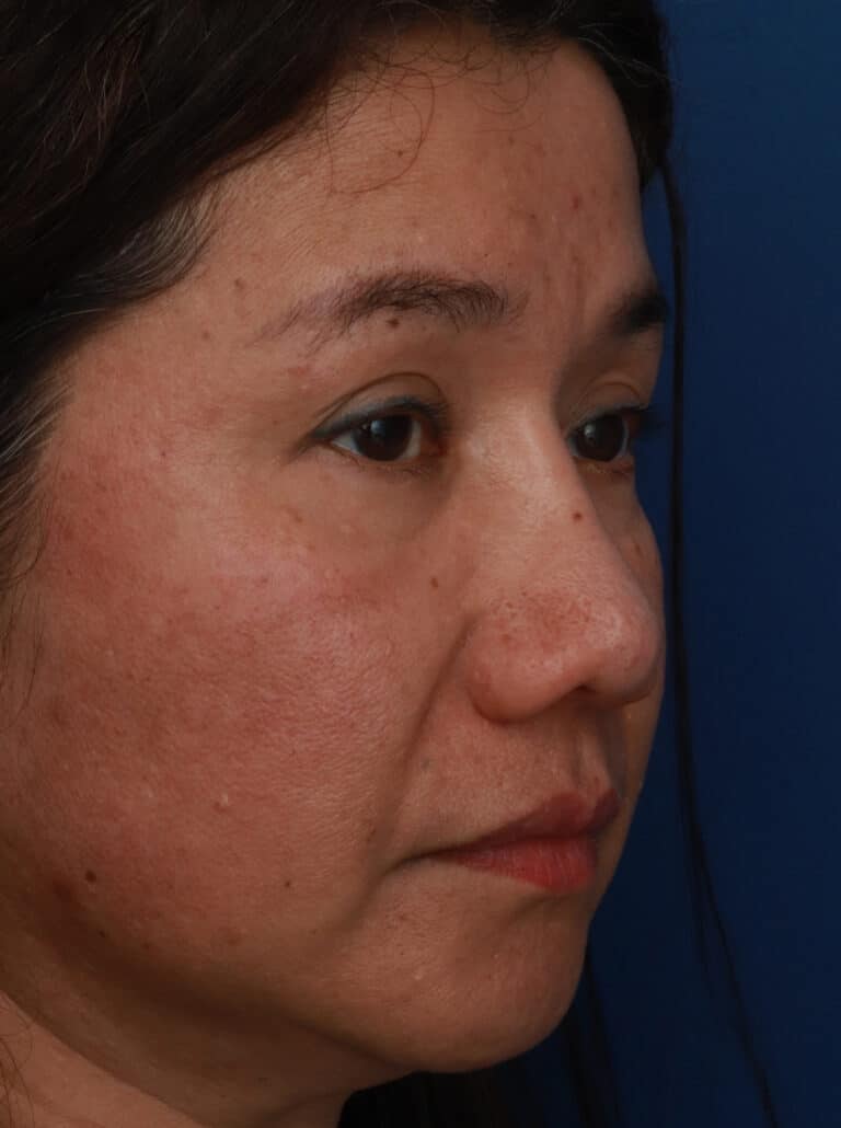 After Image: Ethnic Rhinoplasty - right-front-oblique