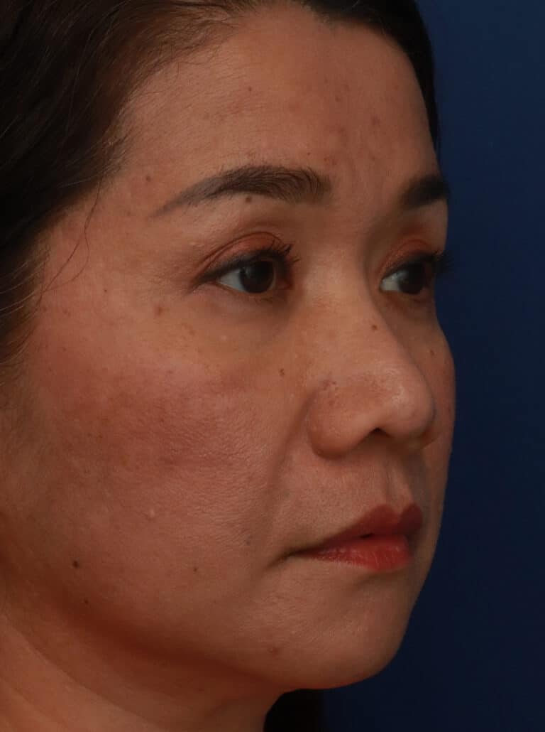 Before Image: Ethnic Rhinoplasty - right-front-oblique